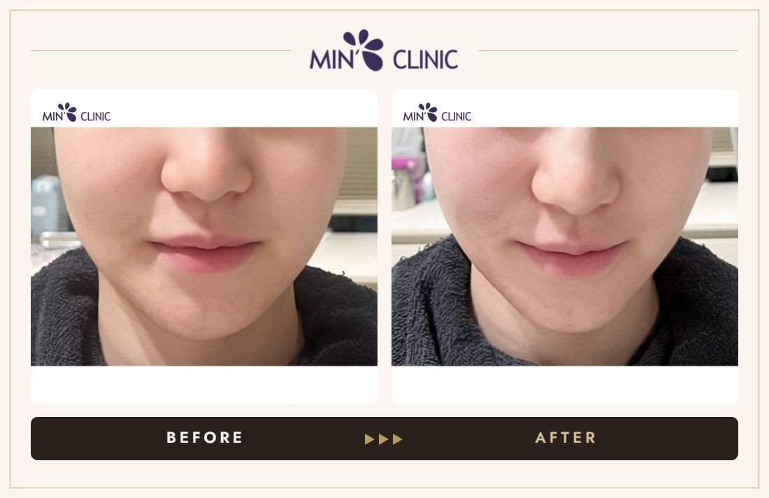 ONDA lifting before and after, case 14 – MIN Clinic Seoul