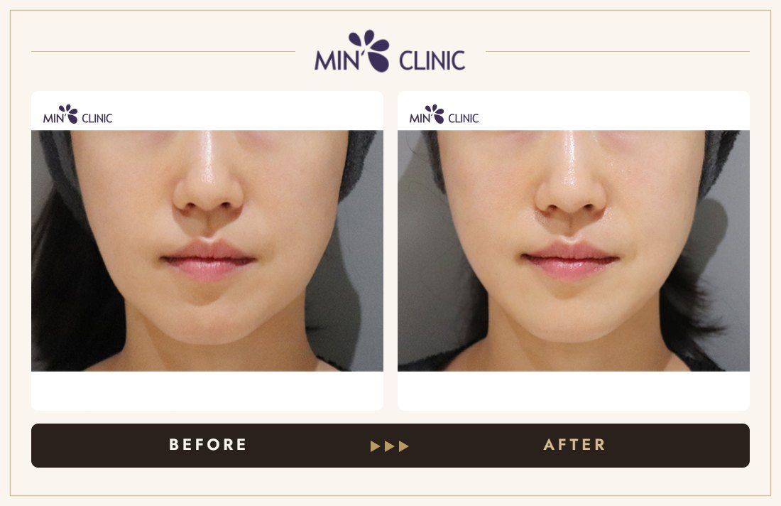 ONDA lifting before and after, case 15 – MIN Clinic Seoul