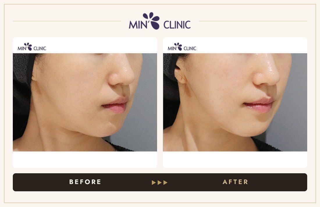 ONDA lifting before and after, case 16 – MIN Clinic Seoul