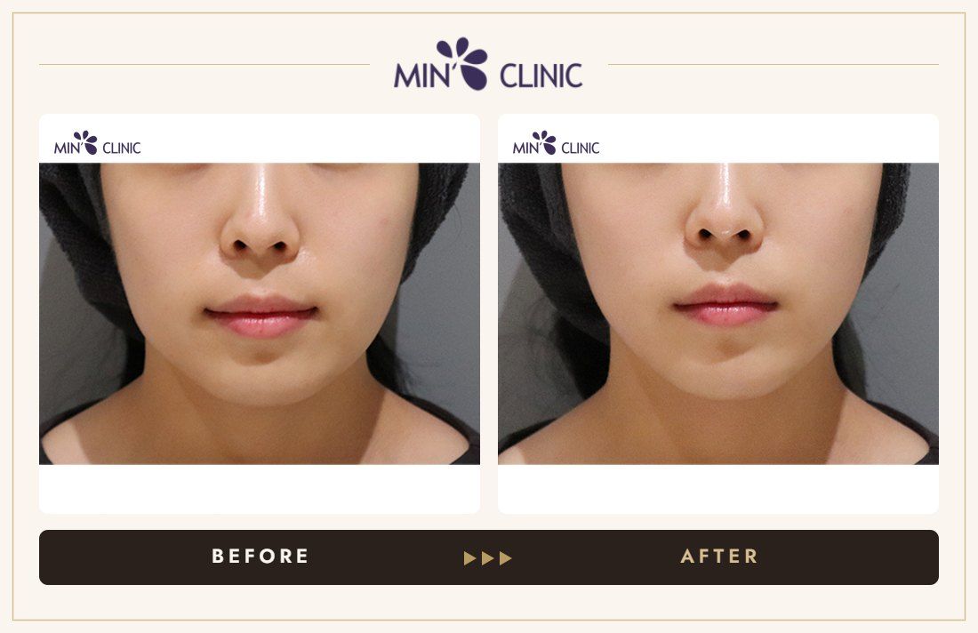 ONDA lifting before and after, case 17 – MIN Clinic Seoul