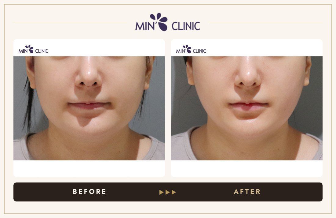 ONDA lifting before and after, case 18 – MIN Clinic Seoul