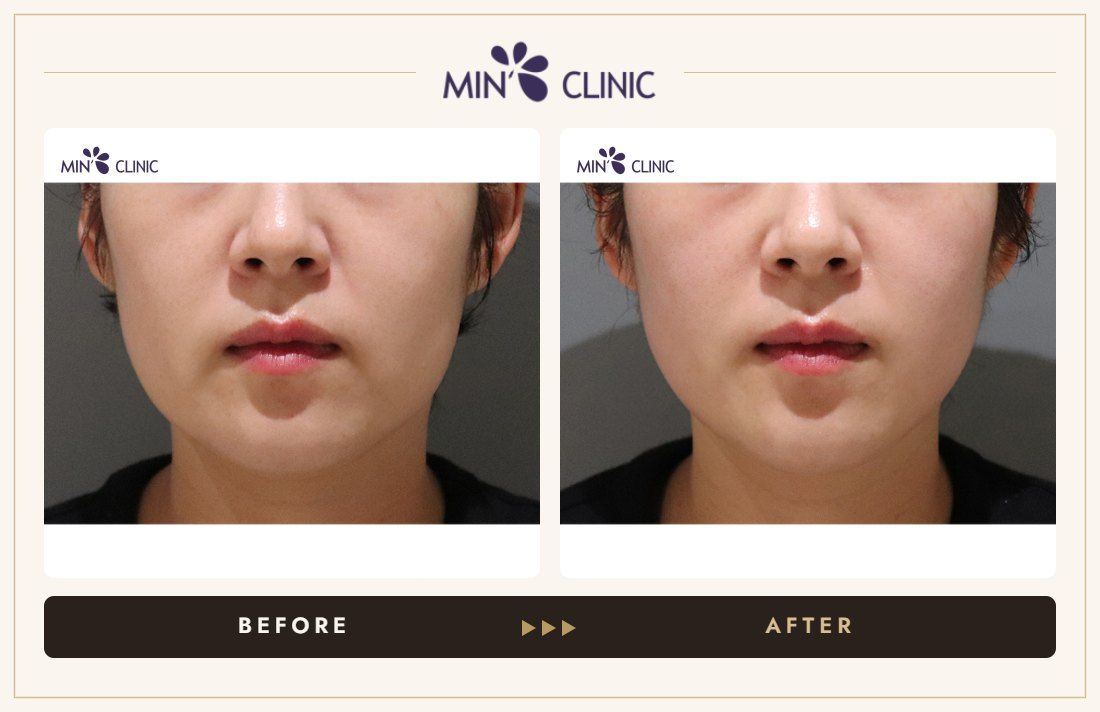 ONDA lifting before and after, case 19 – MIN Clinic Seoul