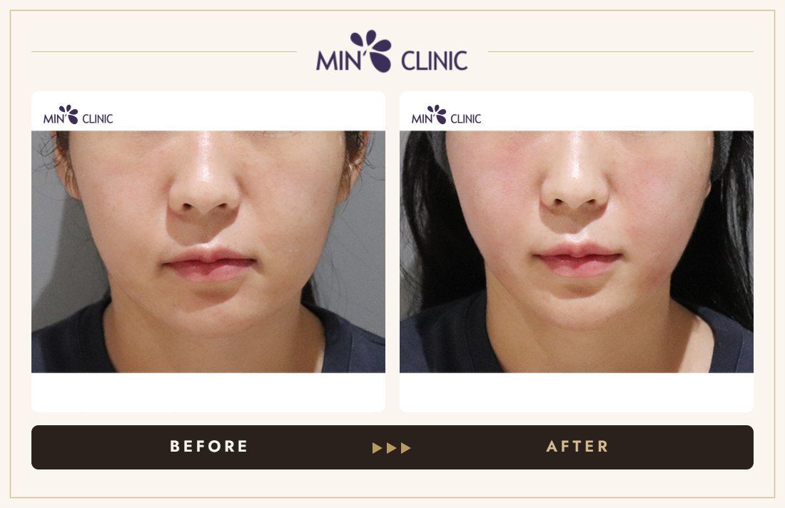 ONDA lifting before and after, case 20 – MIN Clinic Seoul