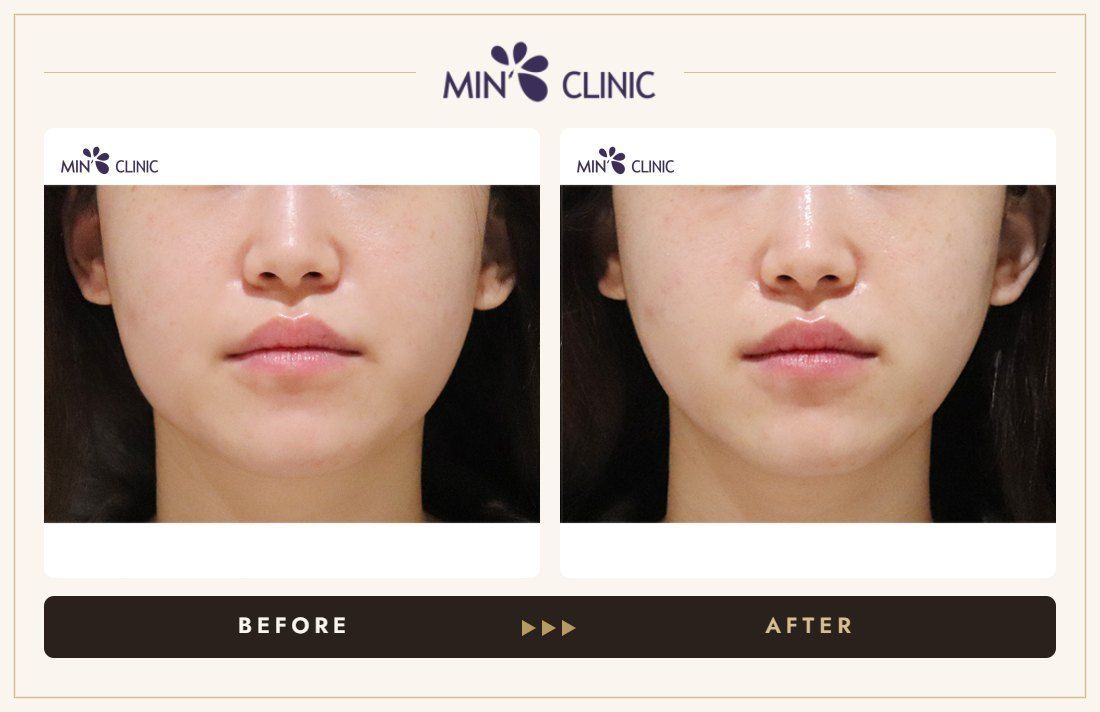 ONDA lifting before and after, case 21 – MIN Clinic Seoul