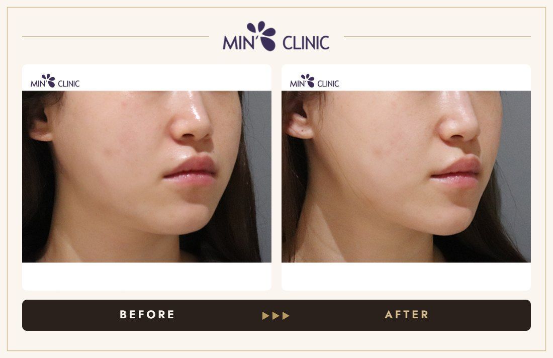 ONDA lifting before and after, case 22 – MIN Clinic Seoul