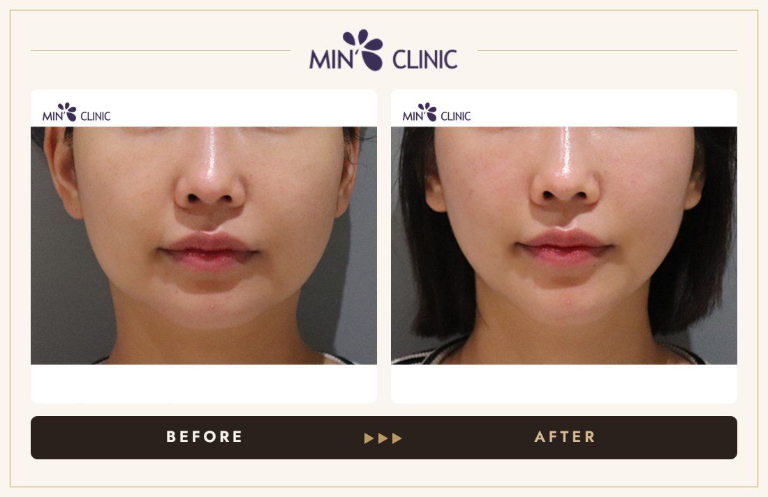 ONDA lifting before and after, case 23 – MIN Clinic Seoul