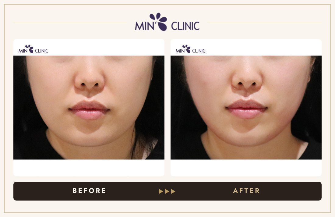 ONDA lifting before and after, case 24 – MIN Clinic Seoul