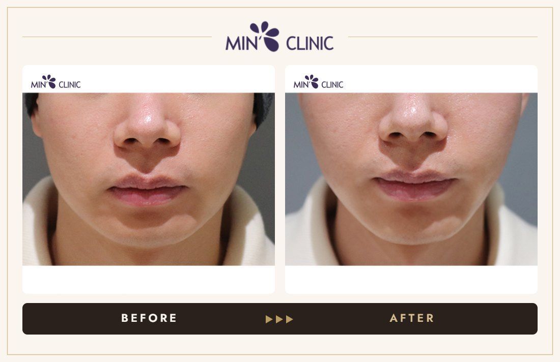 ONDA lifting before and after, case 25 – MIN Clinic Seoul