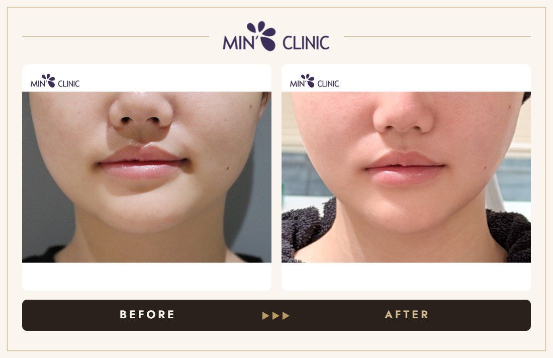 ONDA lifting before and after, case 26 – MIN Clinic Seoul