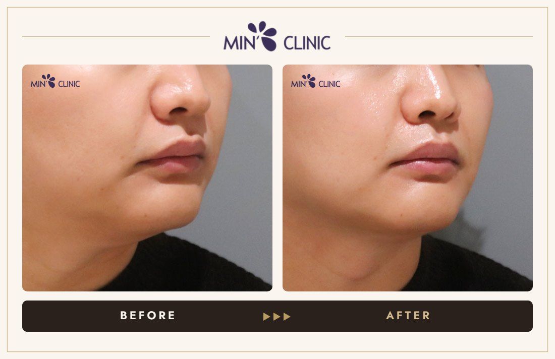 ONDA lifting before and after, case 27 – MIN Clinic Seoul
