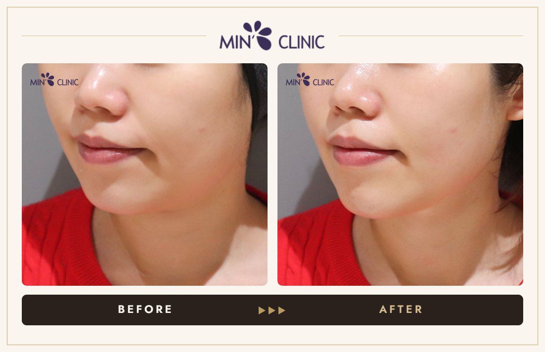 ONDA lifting before and after, case 28 – MIN Clinic Seoul