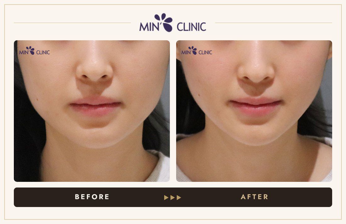 ONDA lifting before and after, case 29 – MIN Clinic Seoul