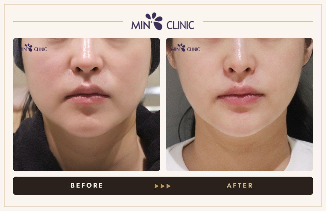 ONDA lifting before and after, case 32 – MIN Clinic Seoul