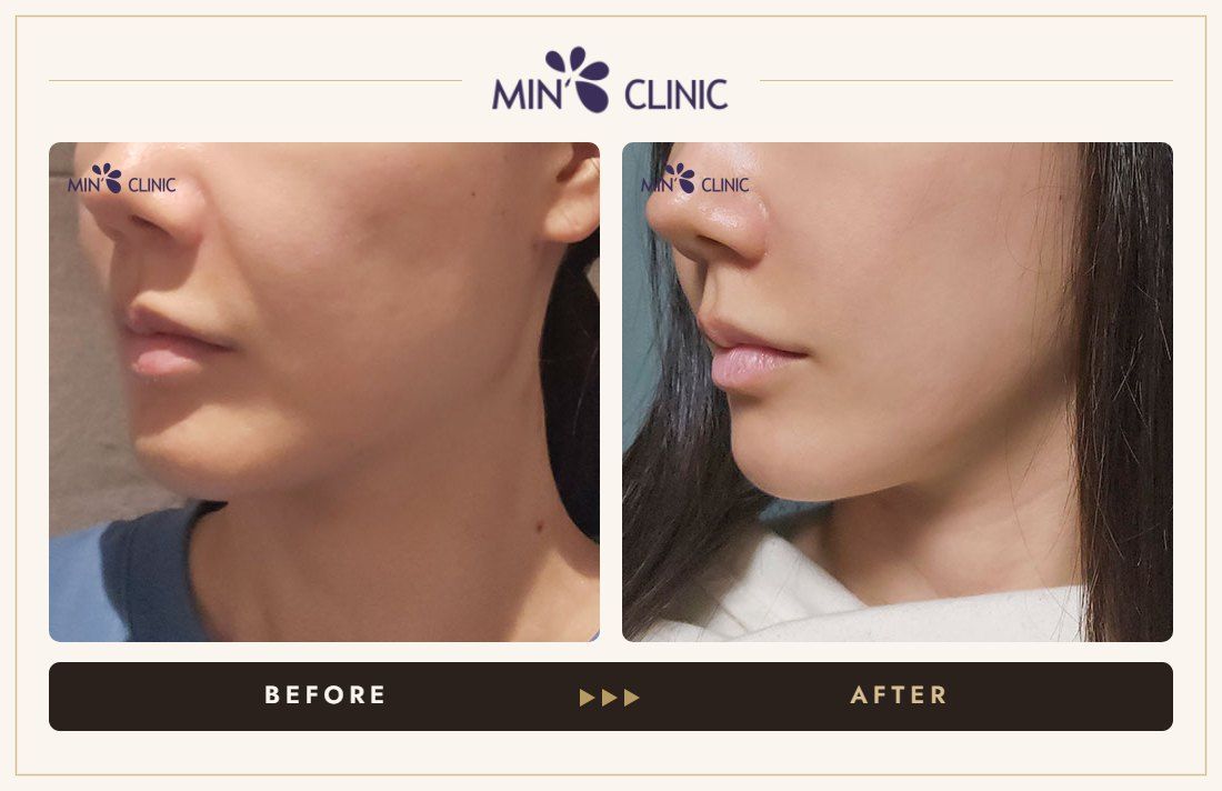 ONDA lifting before and after, case 33 – MIN Clinic Seoul