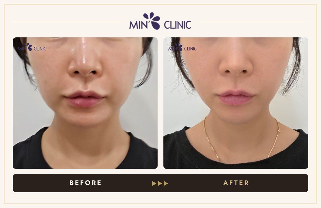 Lifting before and after – MIN Clinic Gangnam, Seoul