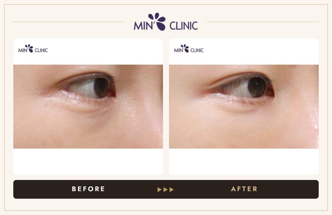 Eye lifting before and after, case 3 – MIN Clinic Seoul