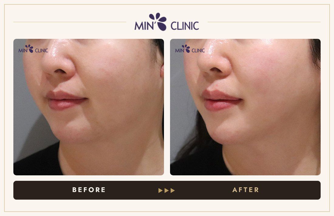 ONDA lifting before and after, case 31 – MIN Clinic Seoul