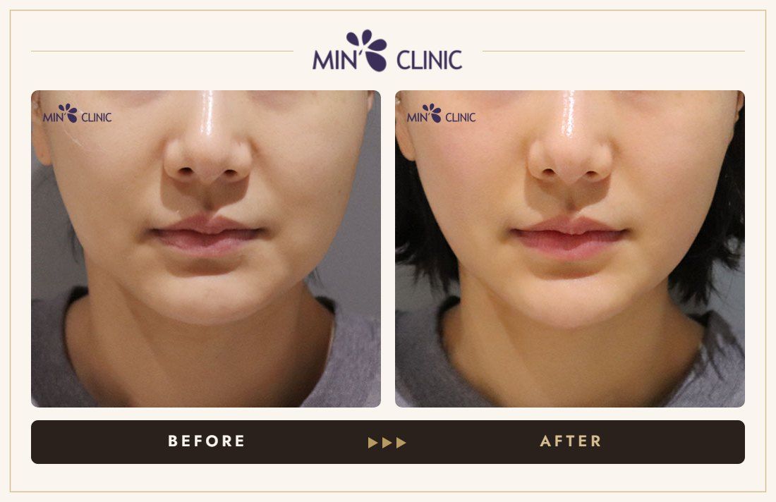 ONDA lifting before and after, case 30 – MIN Clinic Seoul