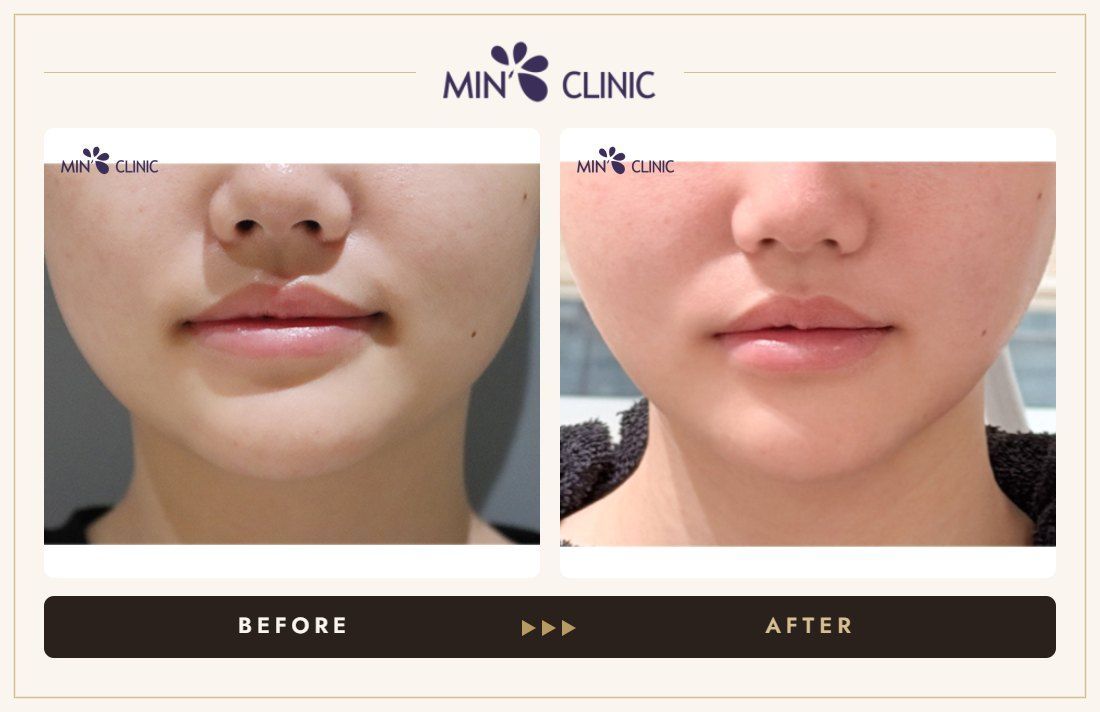 ONDA lifting before and after, case 8 – MIN Clinic Seoul