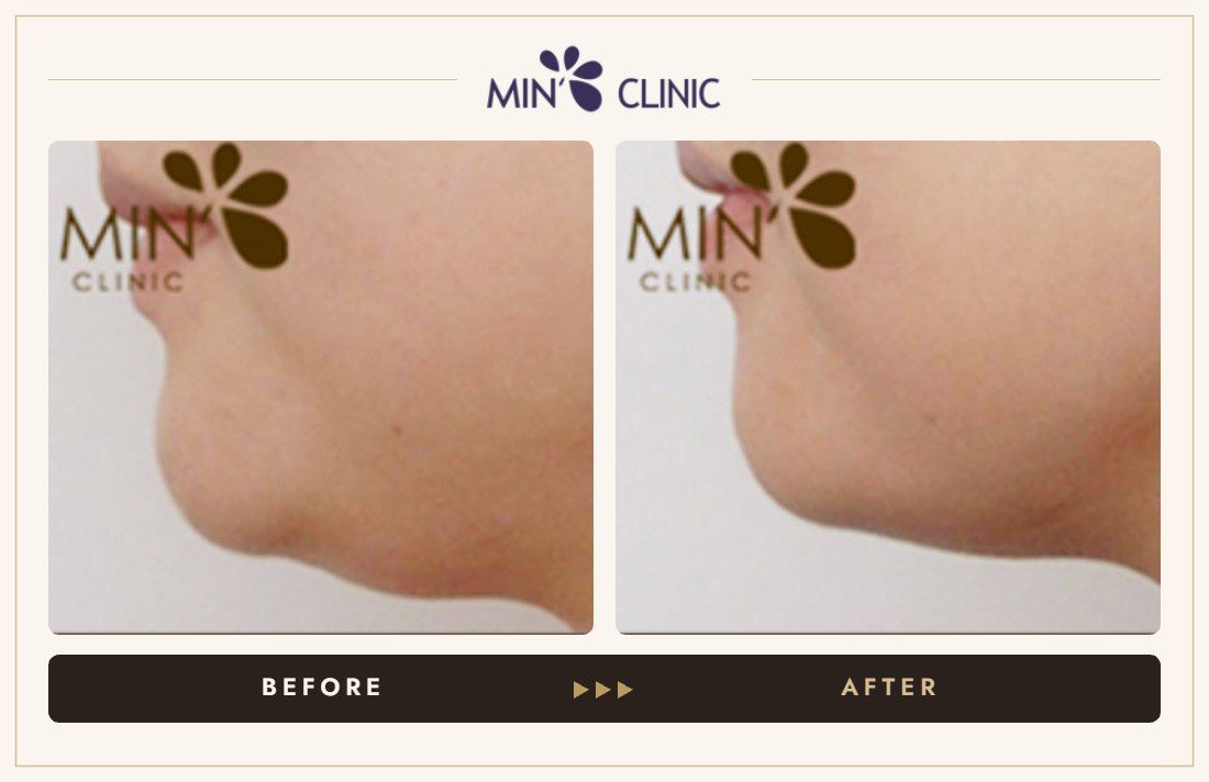 Ulthera lifting before and after, case 4 – MIN Clinic Seoul