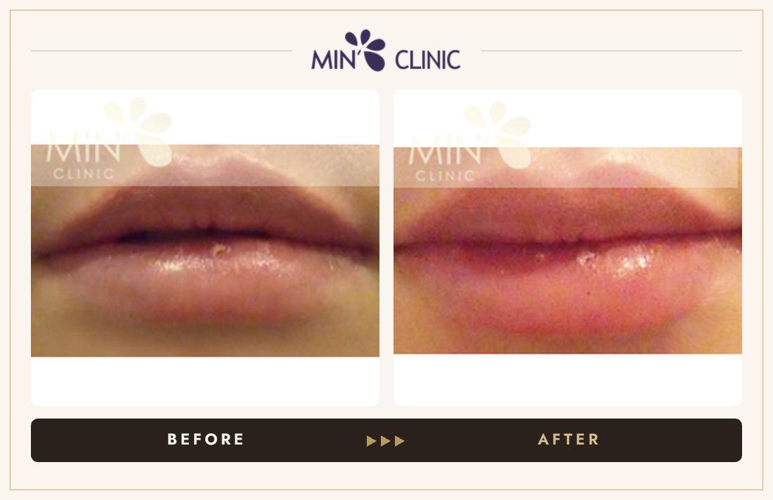 Lip filler before and after, case 1 – MIN Clinic Seoul