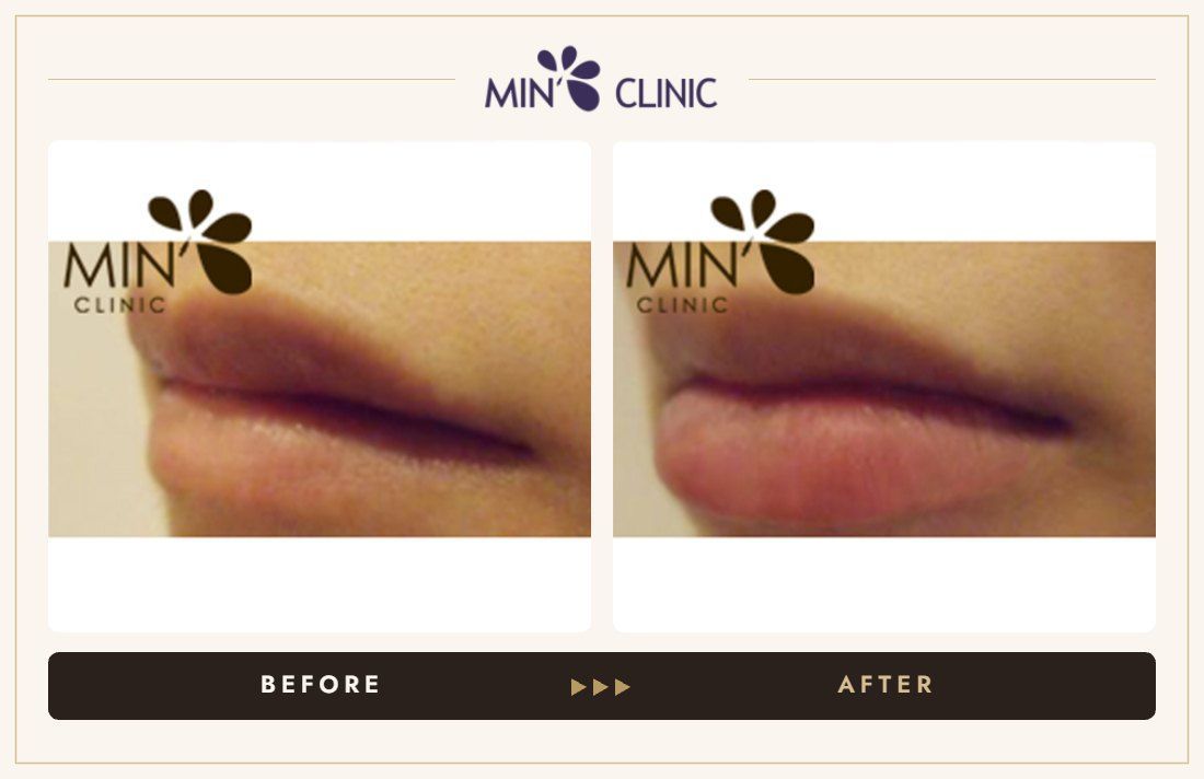 Lip filler before and after, case 2 – MIN Clinic Seoul