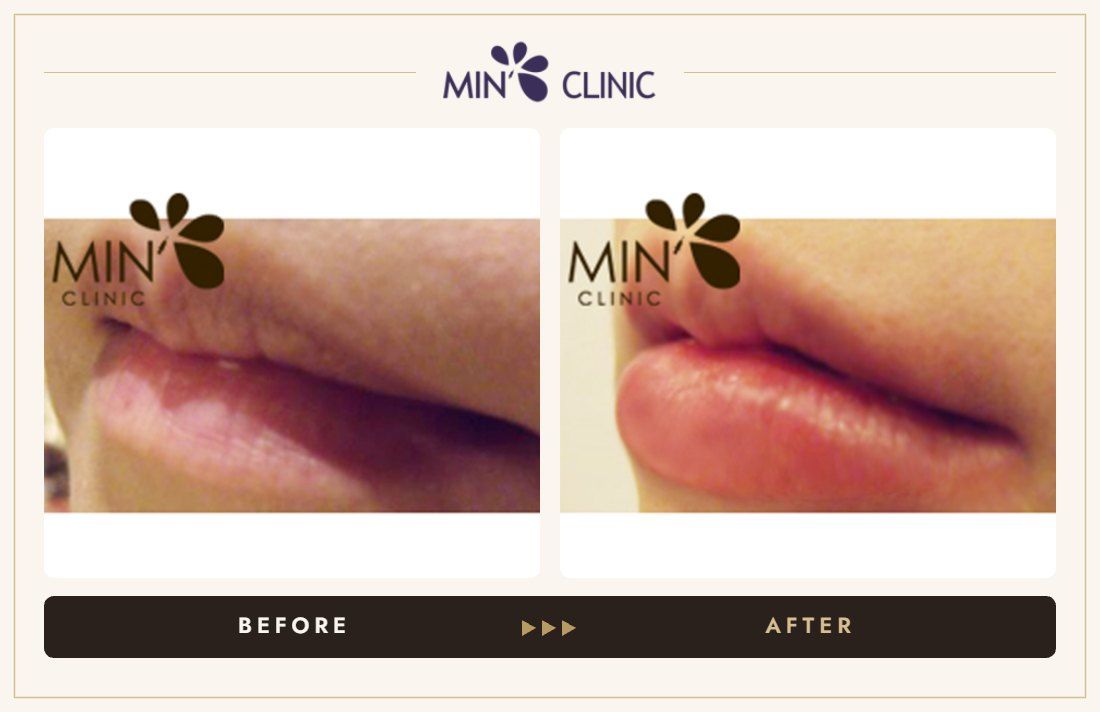 Lip filler before and after, case 3 – MIN Clinic Seoul