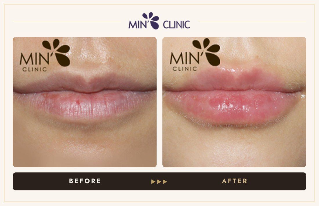 Lip filler before and after, case 4 – MIN Clinic Seoul