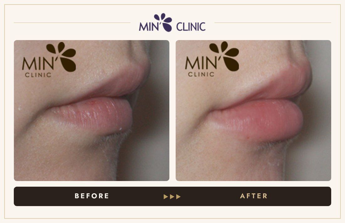 Lip filler before and after, case 5 – MIN Clinic Seoul