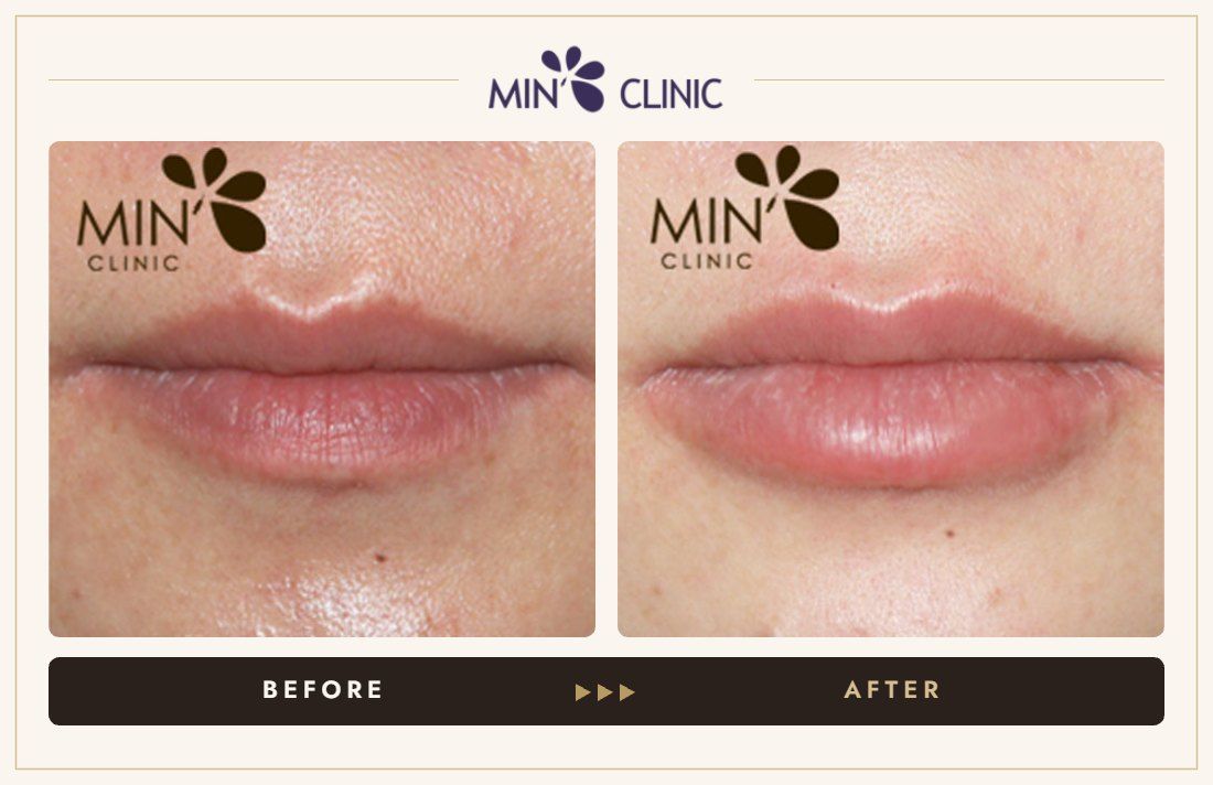 Lip filler before and after, case 6 – MIN Clinic Seoul