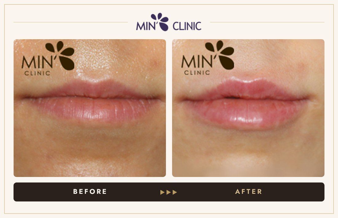 Lip filler before and after, case 7 – MIN Clinic Seoul
