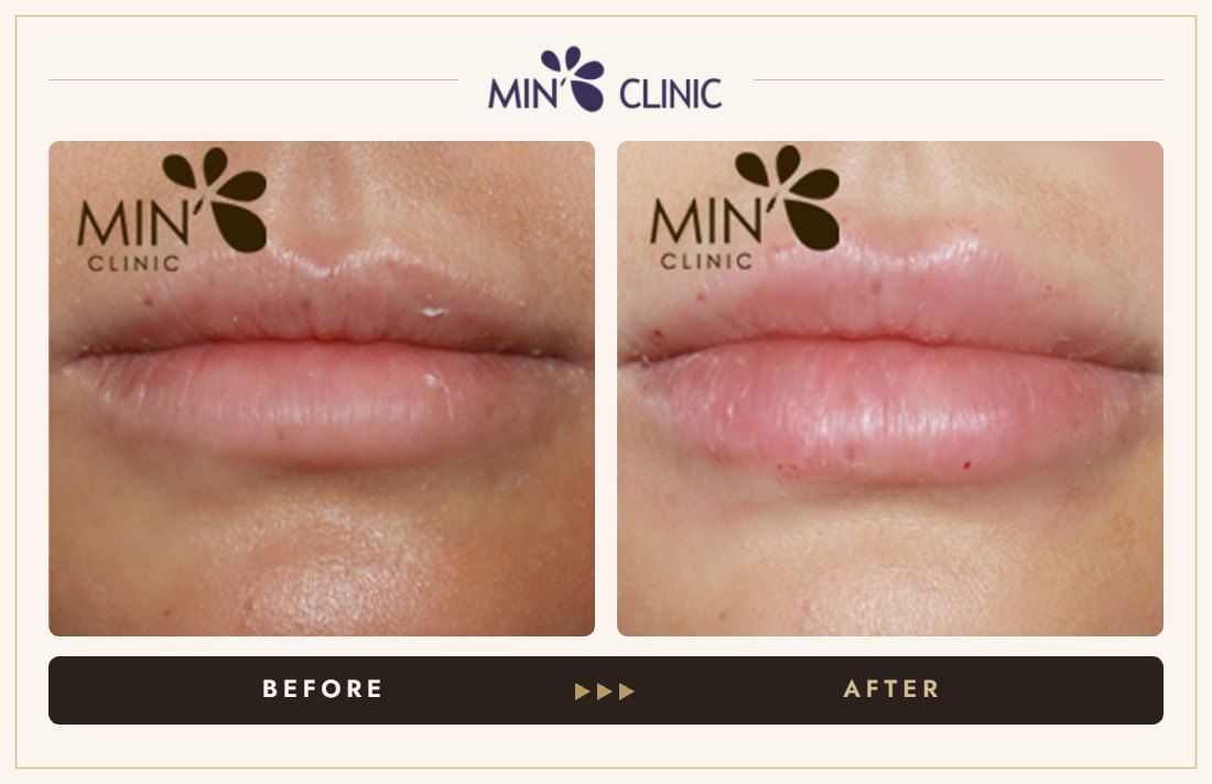 Lip filler before and after, case 8 – MIN Clinic Seoul