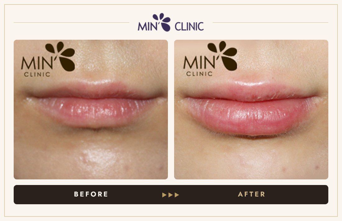 Lip filler before and after, case 9 – MIN Clinic Seoul