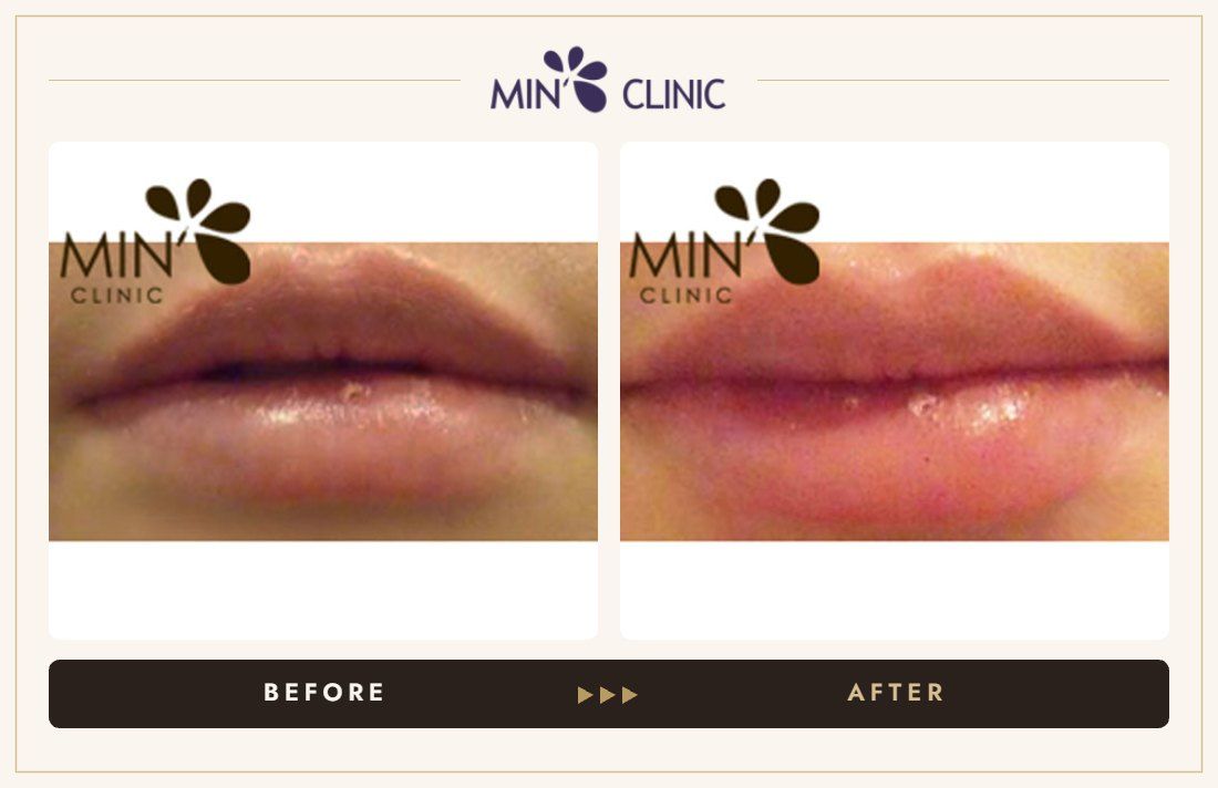 Lip filler before and after, case 10 – MIN Clinic Seoul