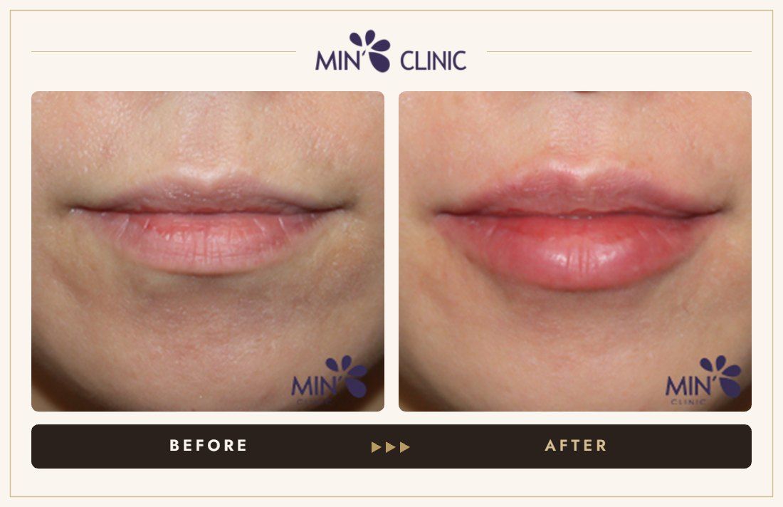Lip filler before and after, case 11 – MIN Clinic Seoul