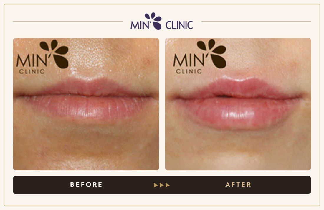 Lip filler before and after, case 12 – MIN Clinic Seoul