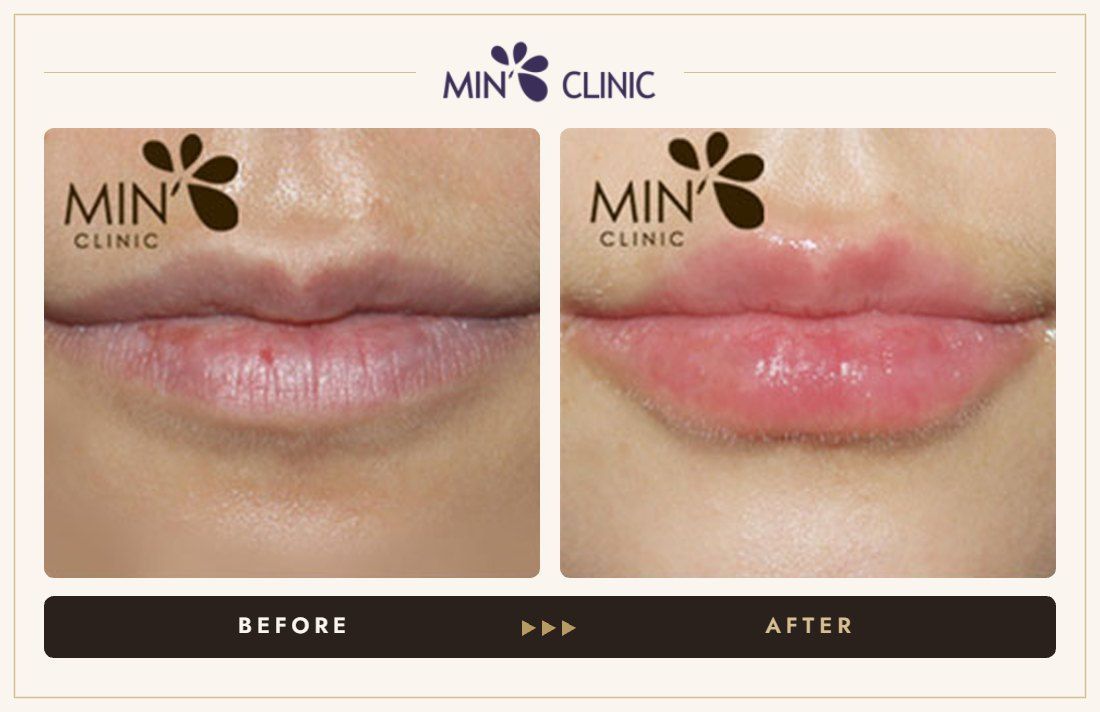 Lip filler before and after, case 13 – MIN Clinic Seoul