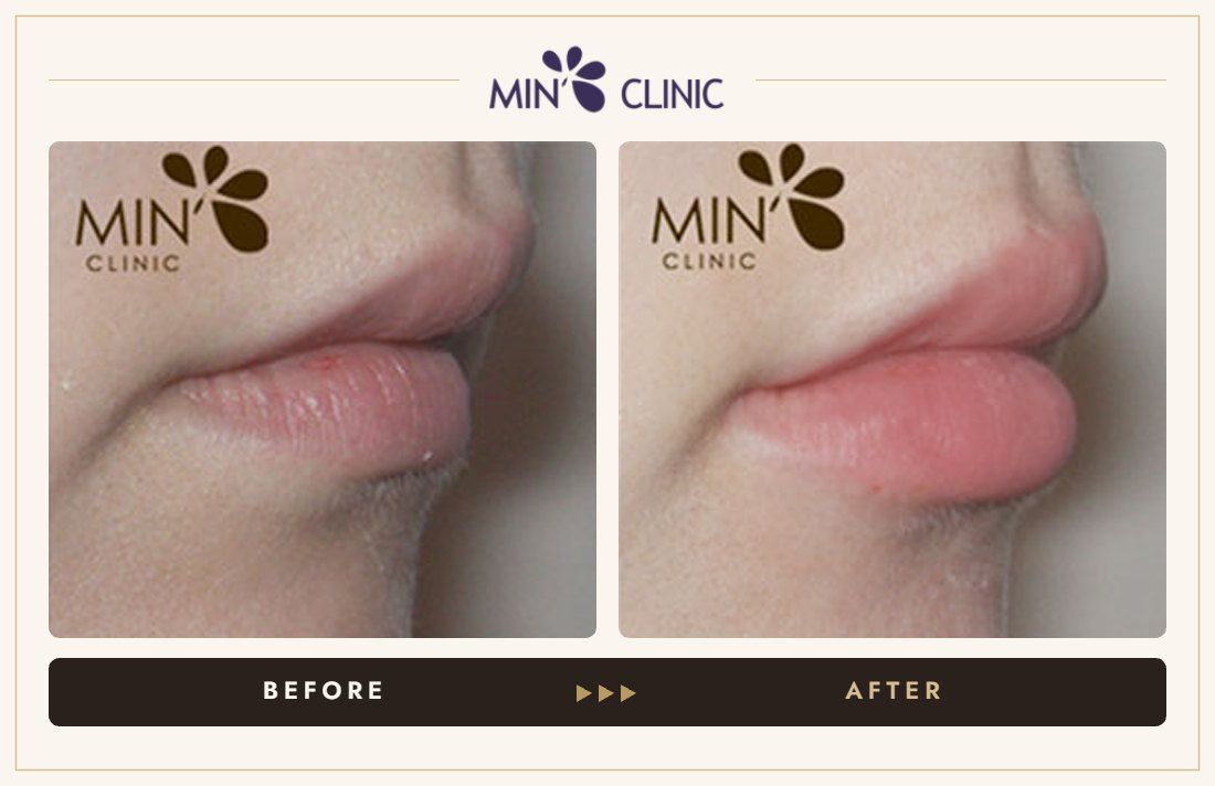 Lip filler before and after, case 14 – MIN Clinic Seoul