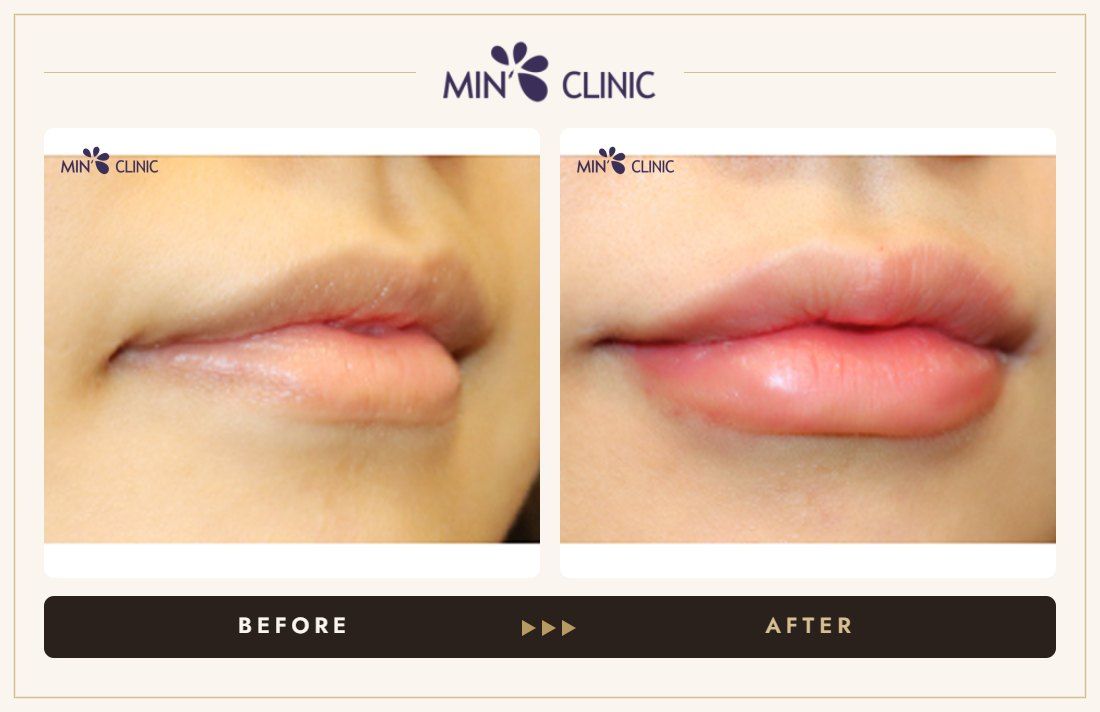 Lip filler before and after, case 15 – MIN Clinic Seoul