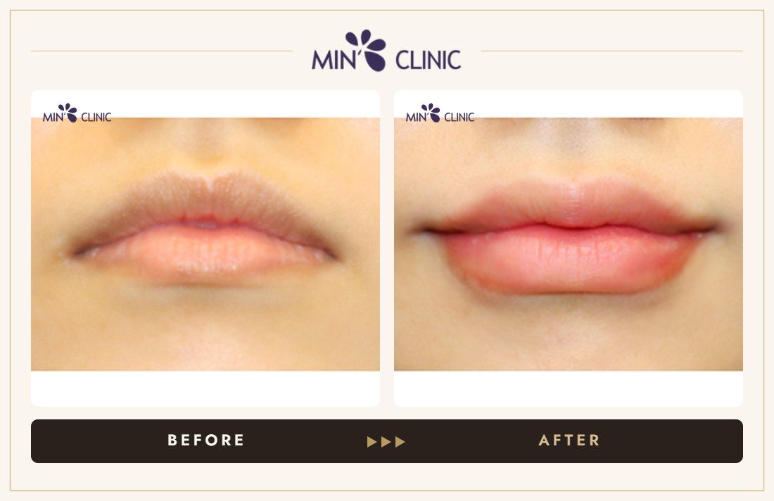 Lip filler before and after, case 16 – MIN Clinic Seoul
