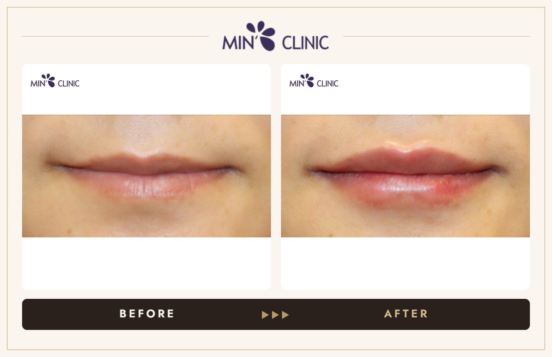 Lip filler before and after, case 17 – MIN Clinic Seoul