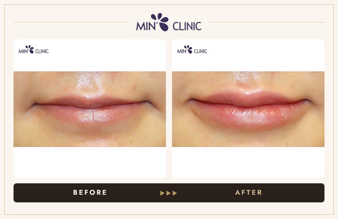 Lip filler before and after, case 18 – MIN Clinic Seoul