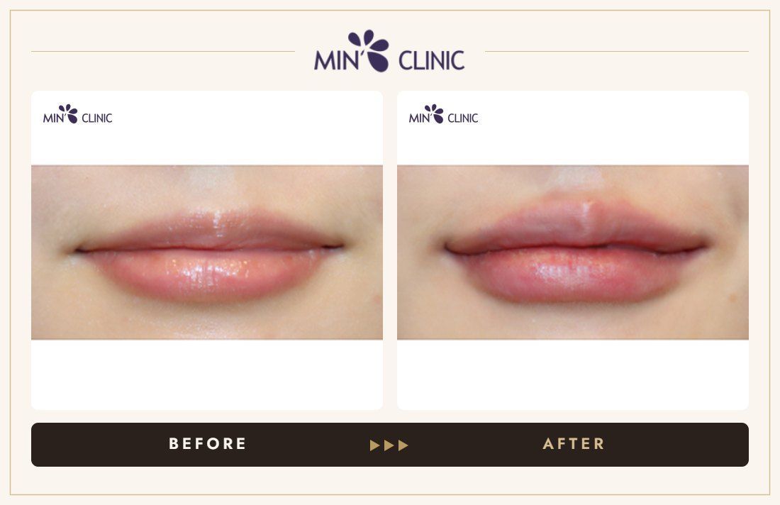 Lip filler before and after, case 19 – MIN Clinic Seoul