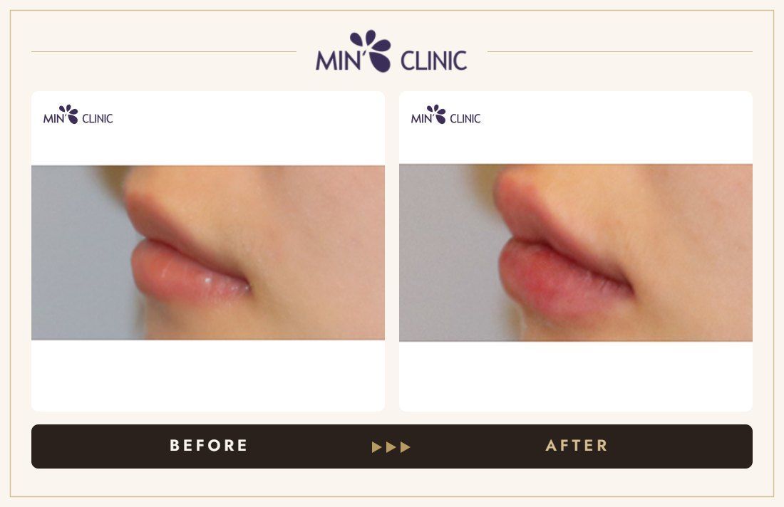 Lip filler before and after, case 20 – MIN Clinic Seoul