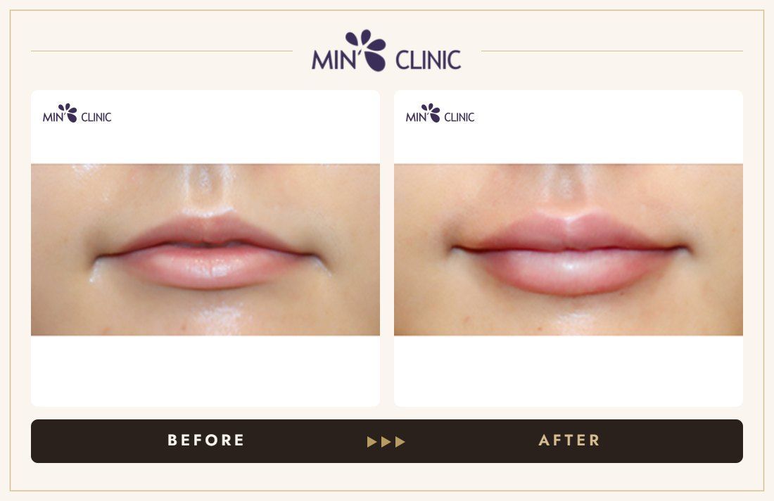 Lip filler before and after, case 21 – MIN Clinic Seoul