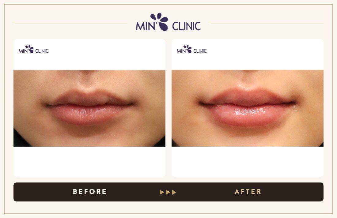 Lip filler before and after, case 22 – MIN Clinic Seoul