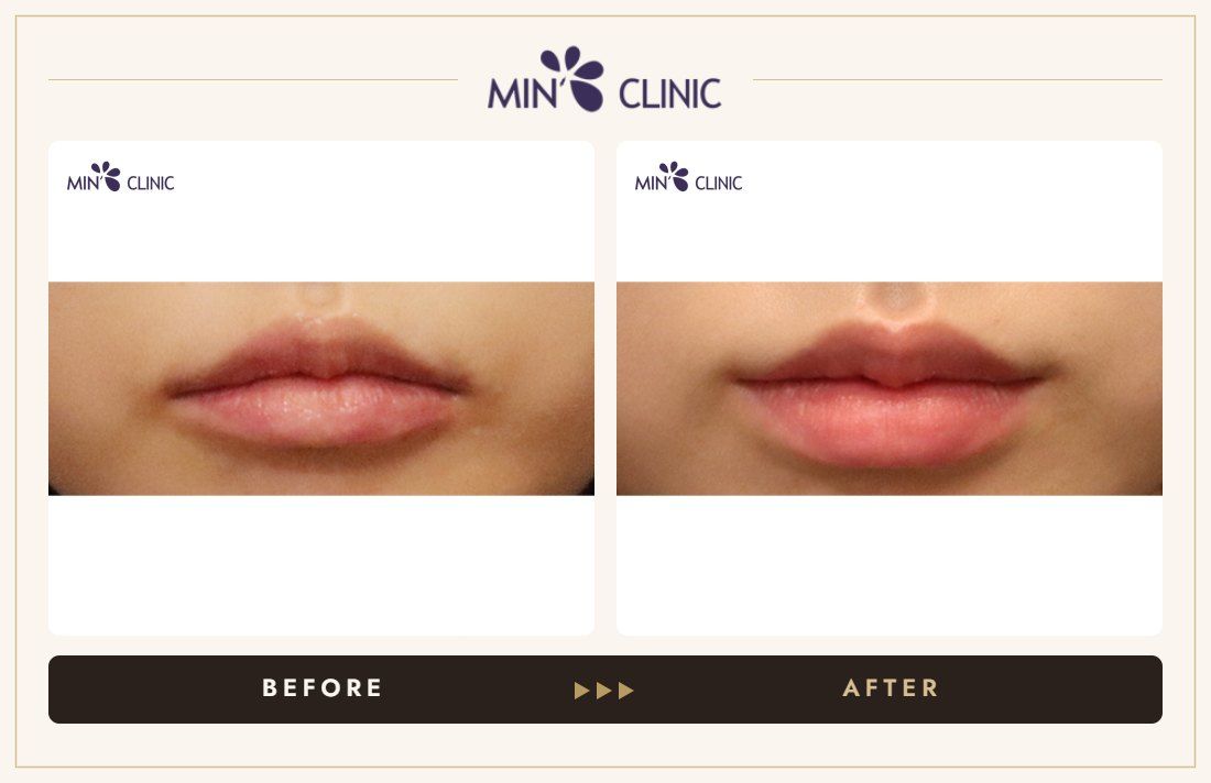 Lip filler before and after, case 23 – MIN Clinic Seoul