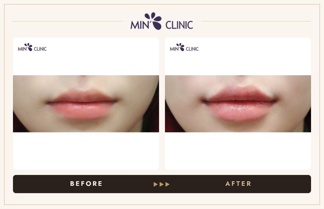 Lip filler before and after, case 24 – MIN Clinic Seoul