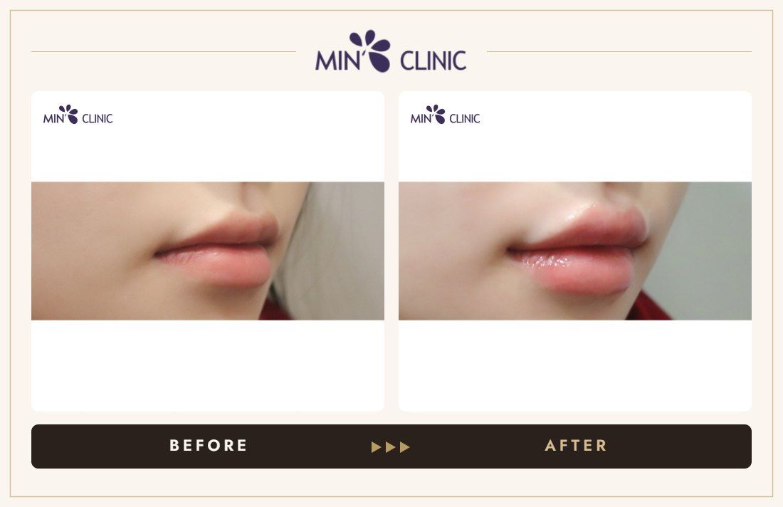 Lip filler before and after, case 25 – MIN Clinic Seoul