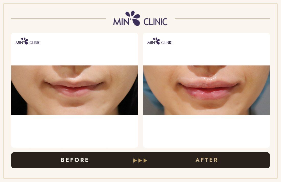 Lip filler before and after, case 26 – MIN Clinic Seoul